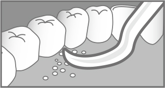 歯の裏側の取りにくい歯垢・食べカスはピックでお取りください。
